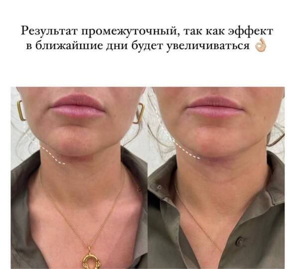 Коррекция формы подбородка до и после фото 2