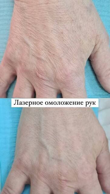 Лазерное омоложение до и после фото 6